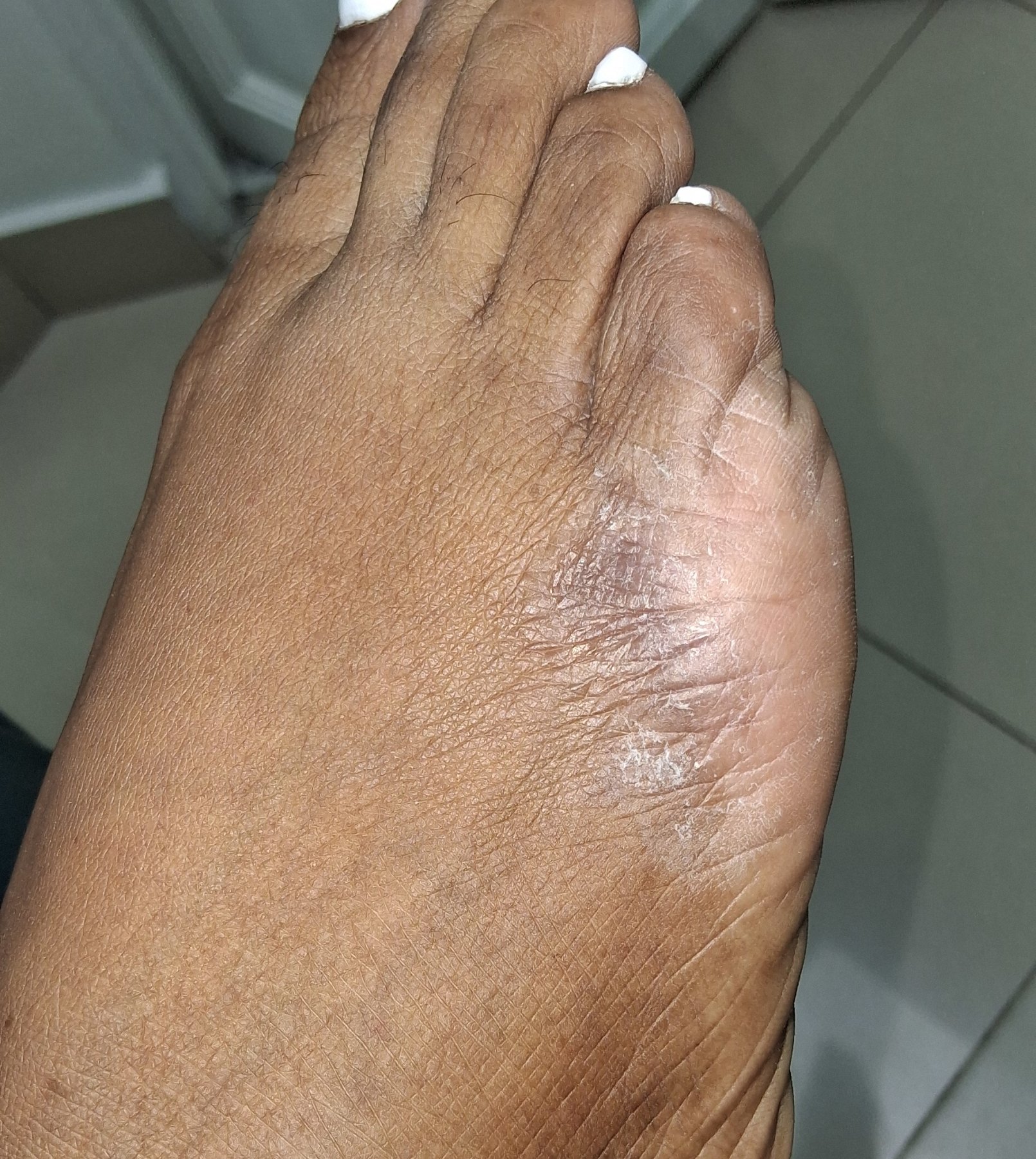 Dermatitis: after image