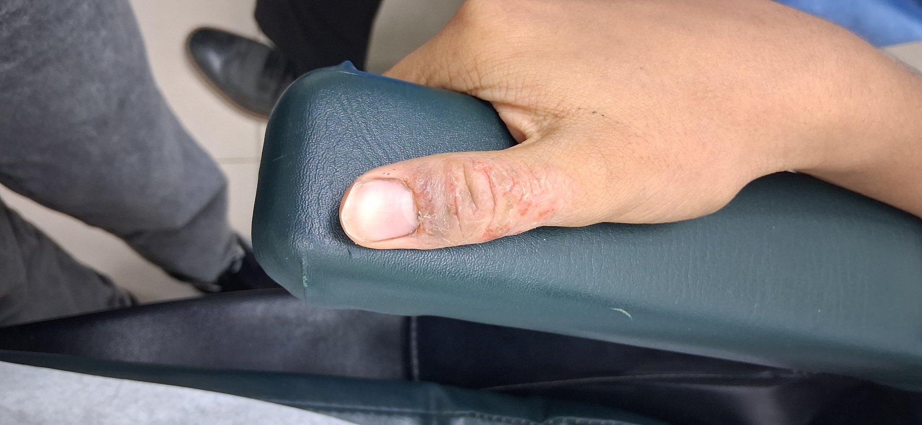 Infected dermatitis: before image