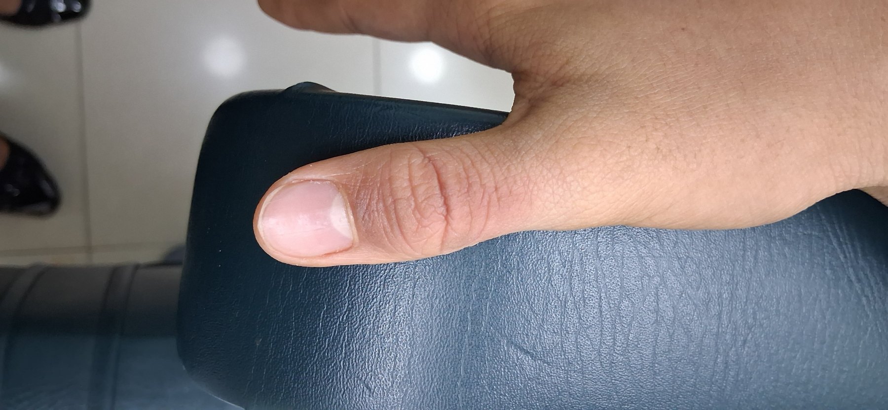 Infected dermatitis: after image