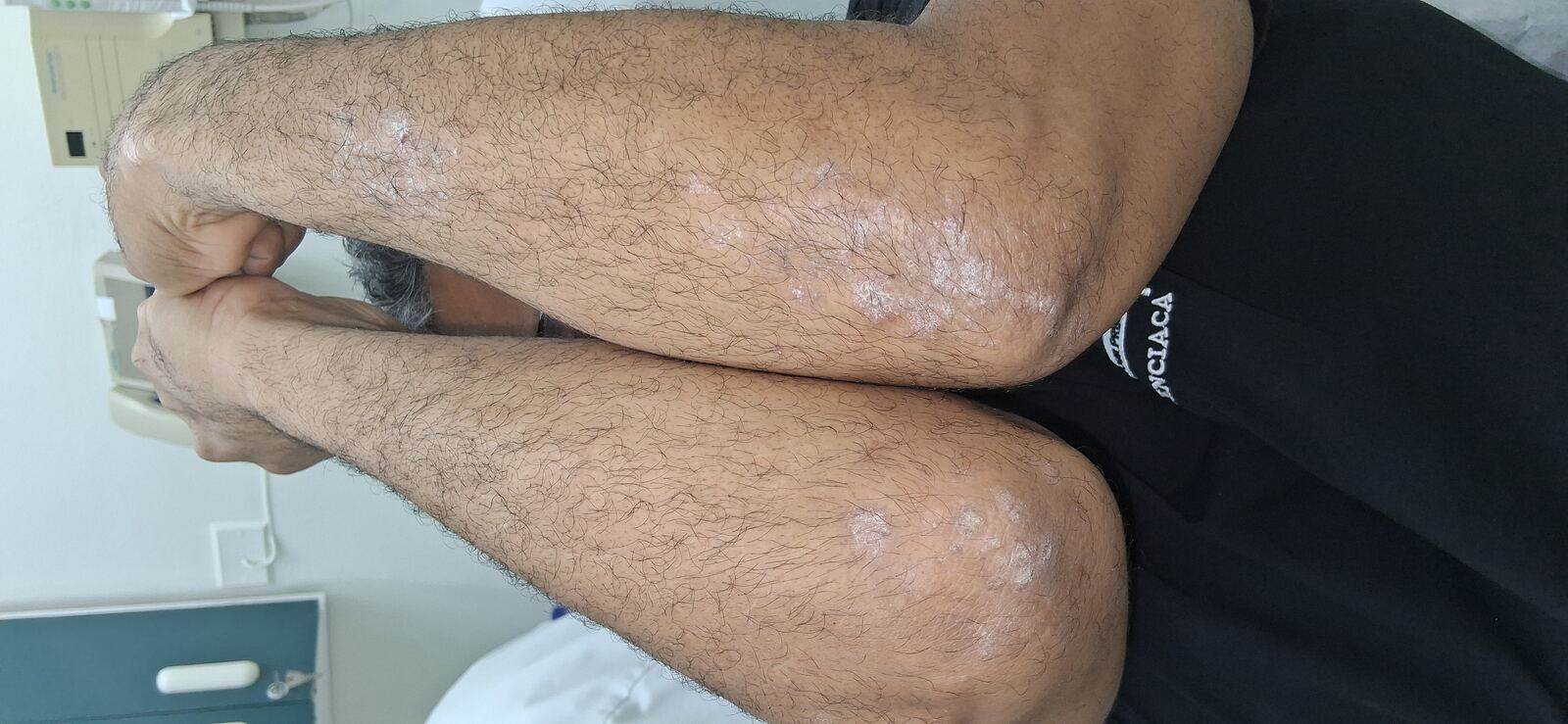 Lichenoid dermatitis vs psoriasis: before image