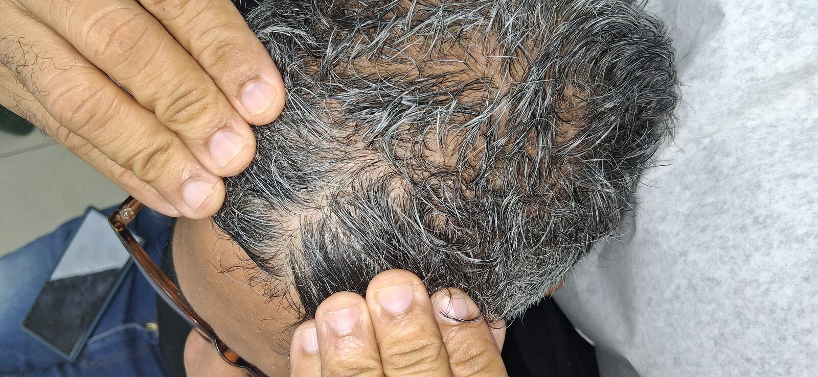 Lichenoid dermatitis vs psoriasis: after image