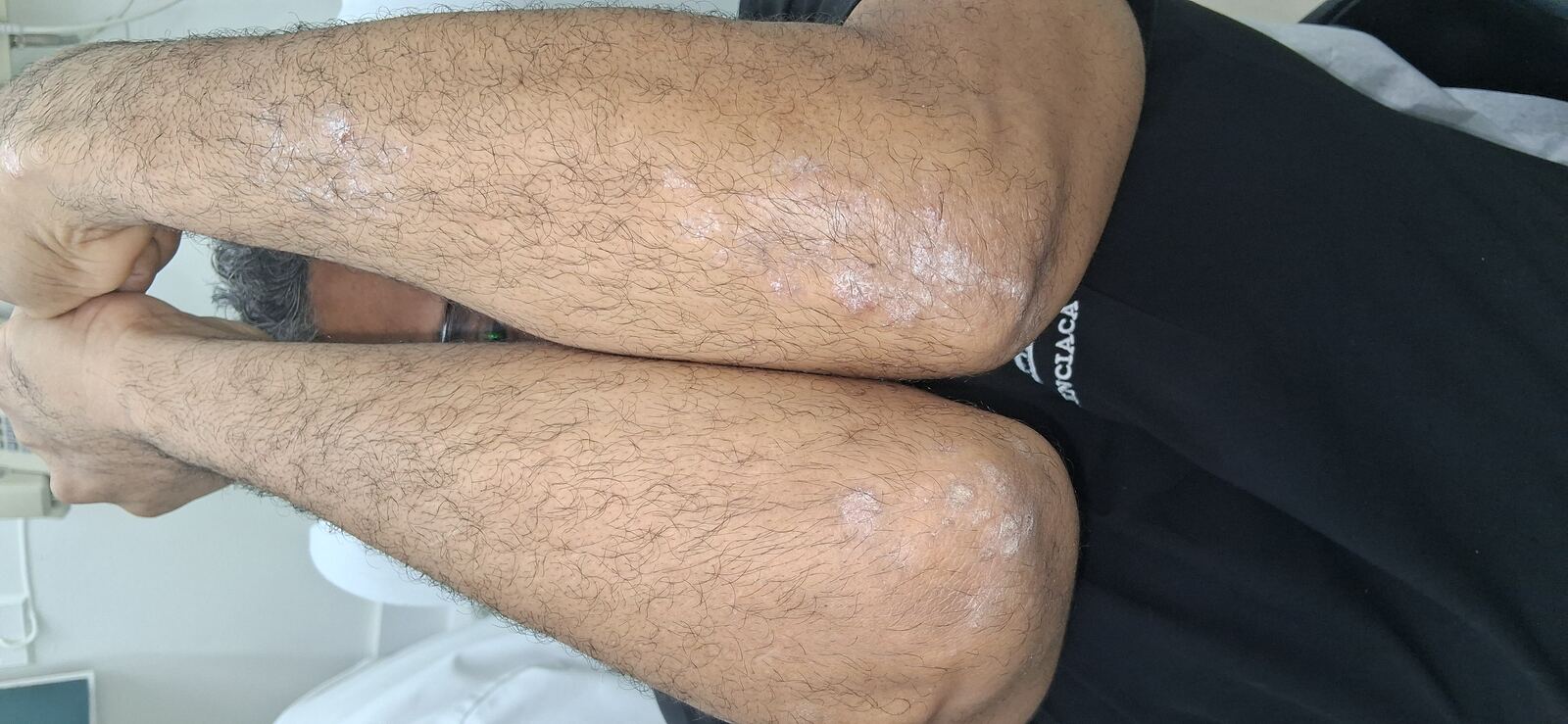 Clinical case: Lichenoid dermatitis vs psoriasis