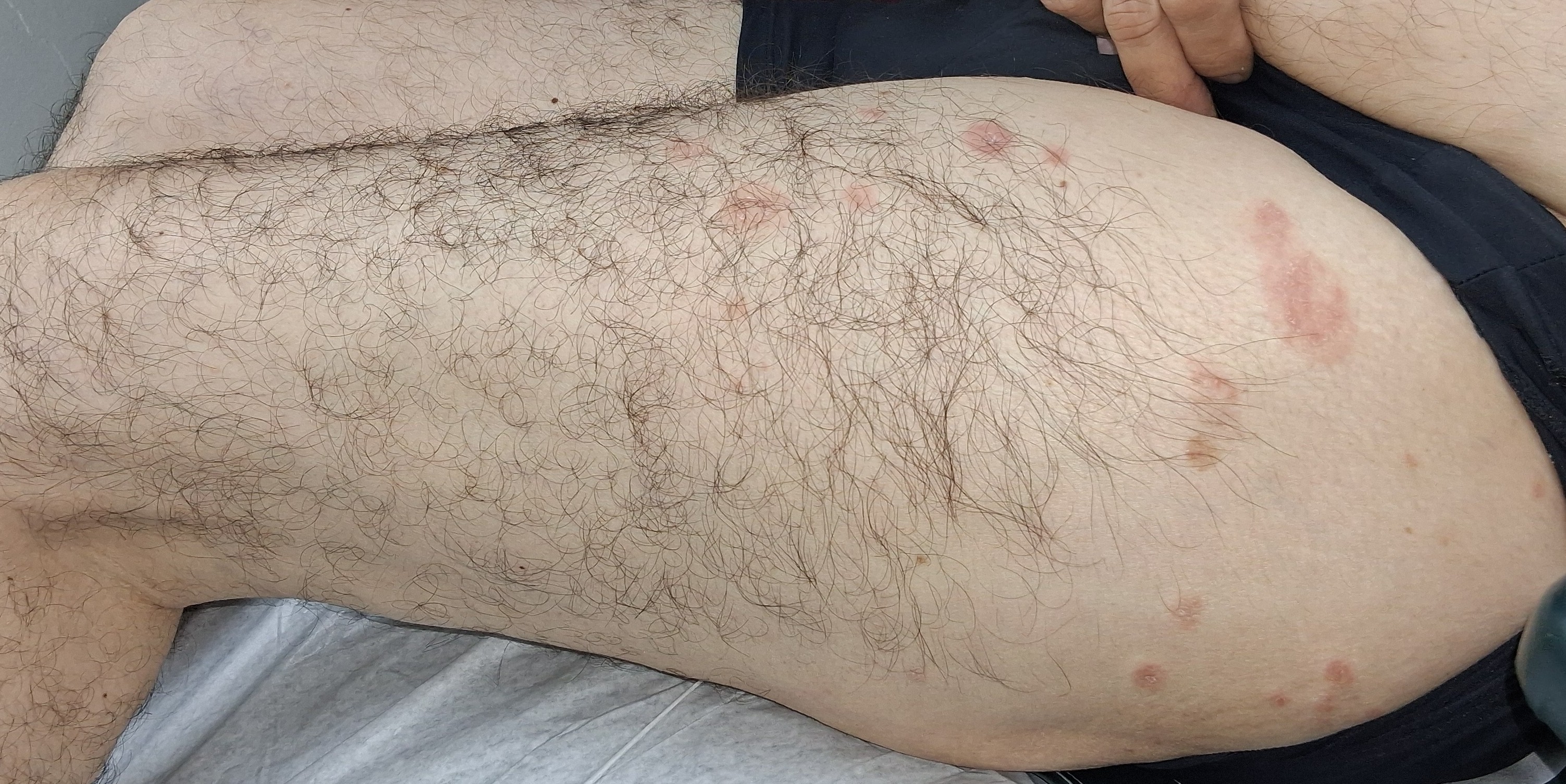 Nummular dermatitis: before image