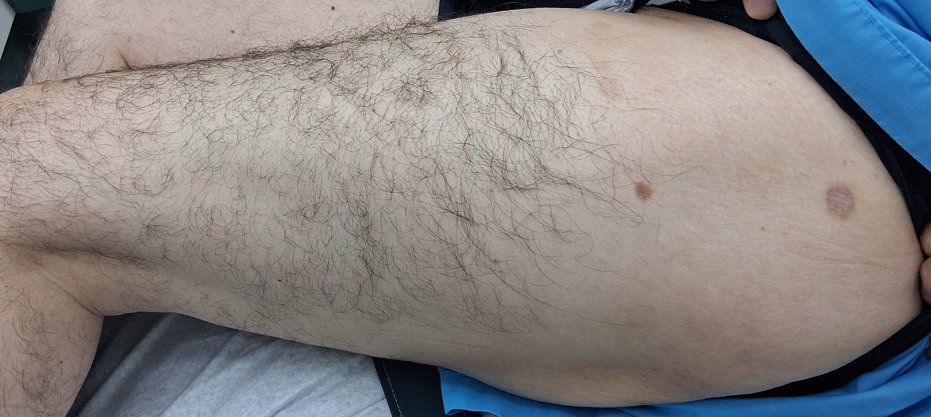 Nummular dermatitis: after image