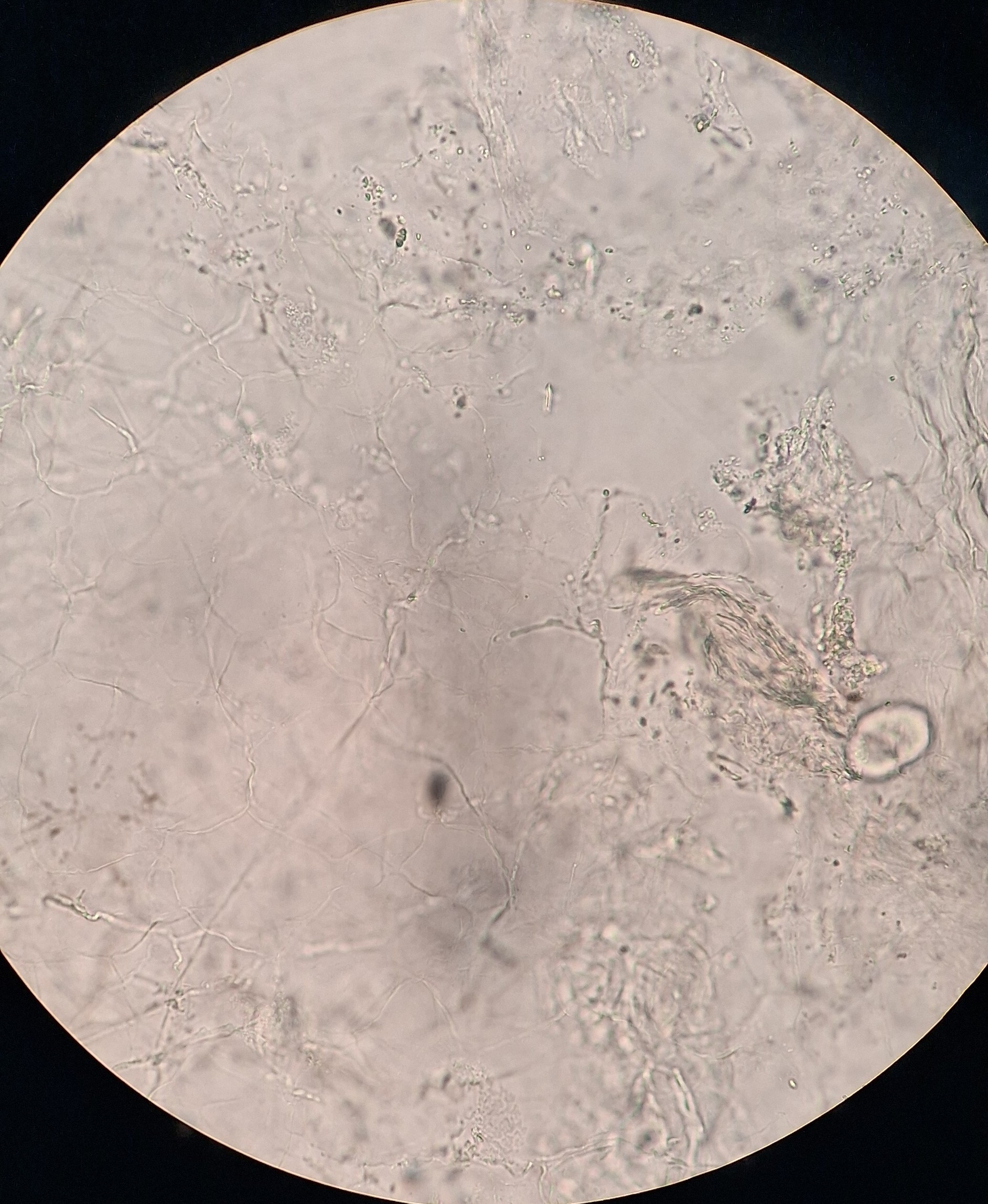Clinical case: Nummular dermatitis