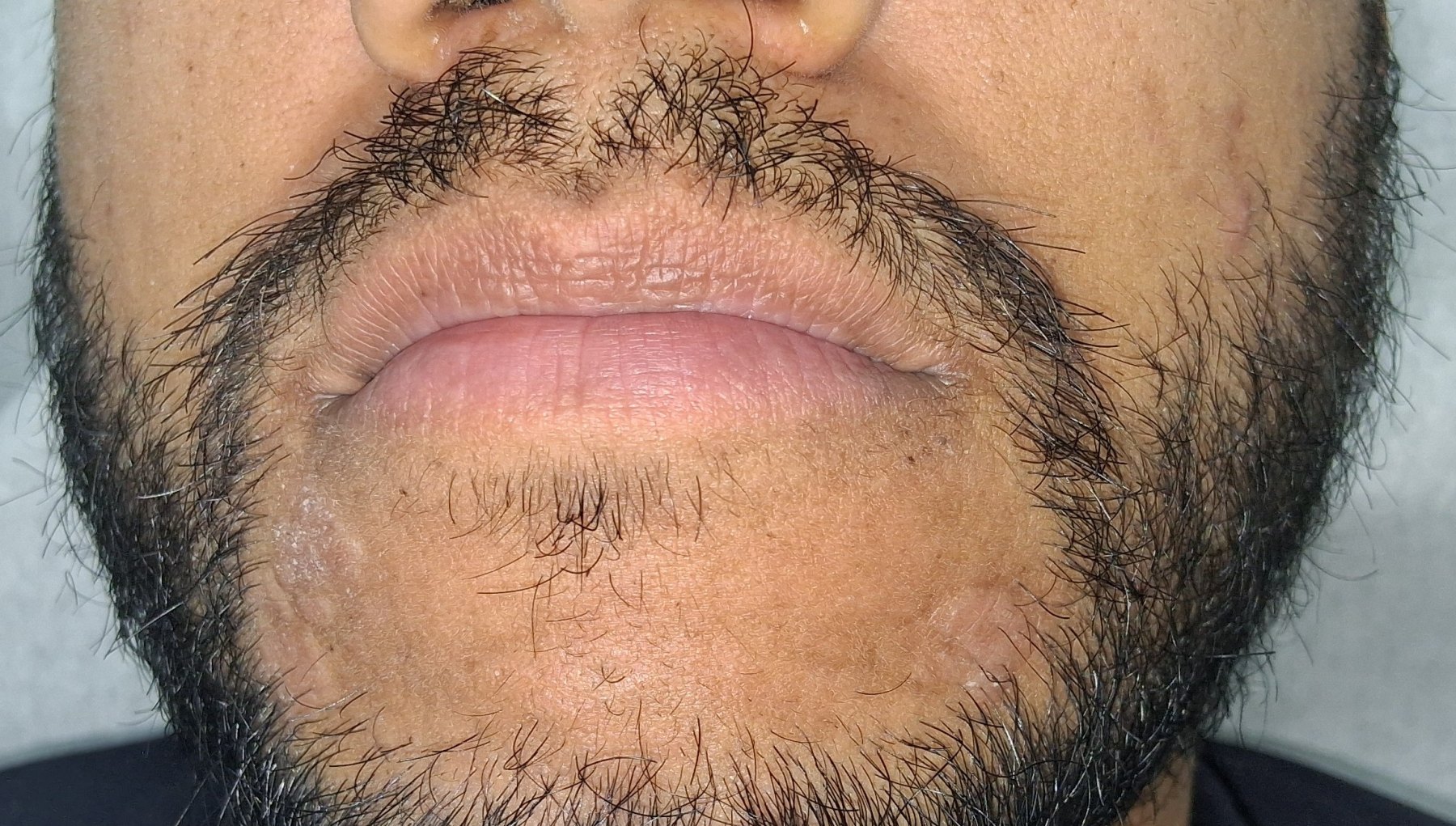 Perioral dermatitis: before image