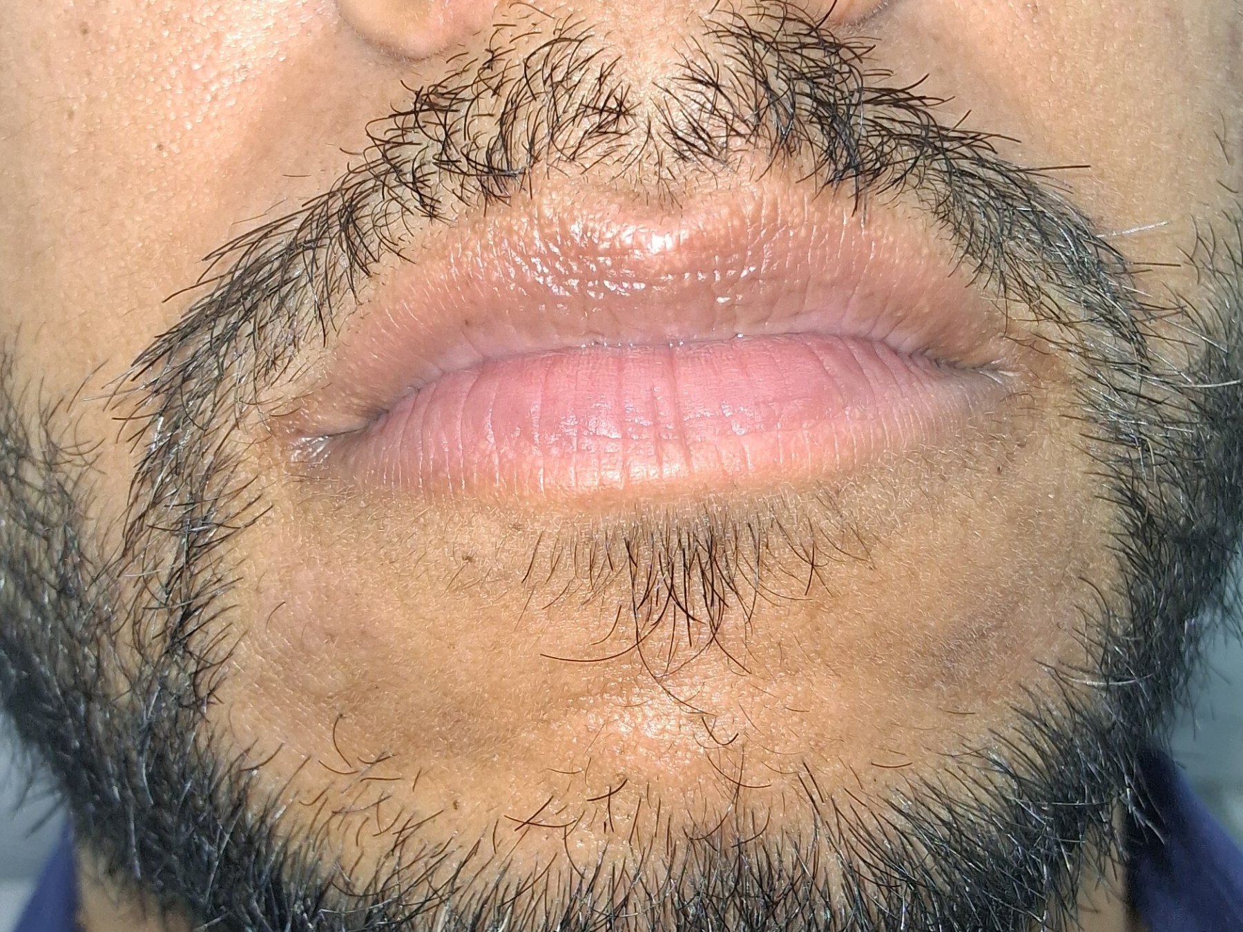 Perioral dermatitis: after image