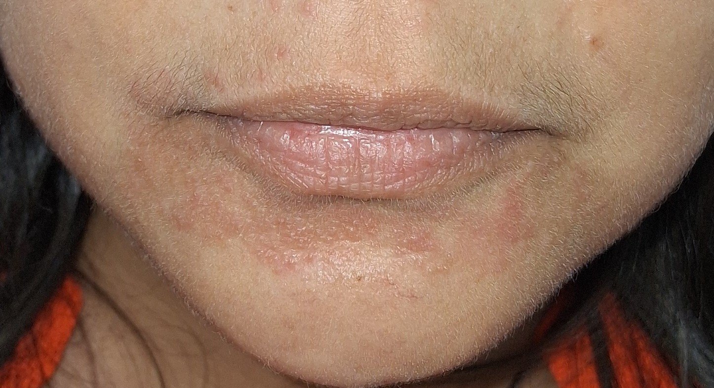 Perioral dermatitis: before image