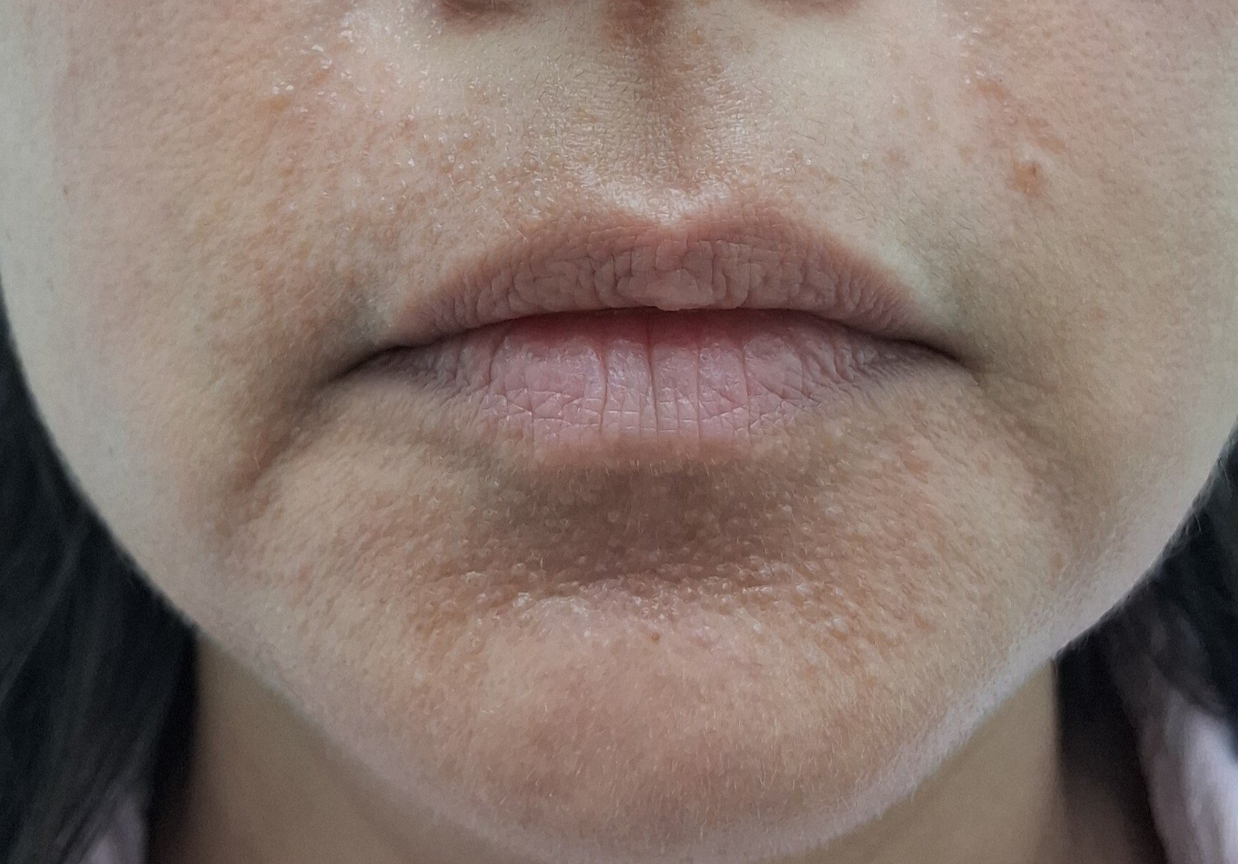 Perioral dermatitis: after image