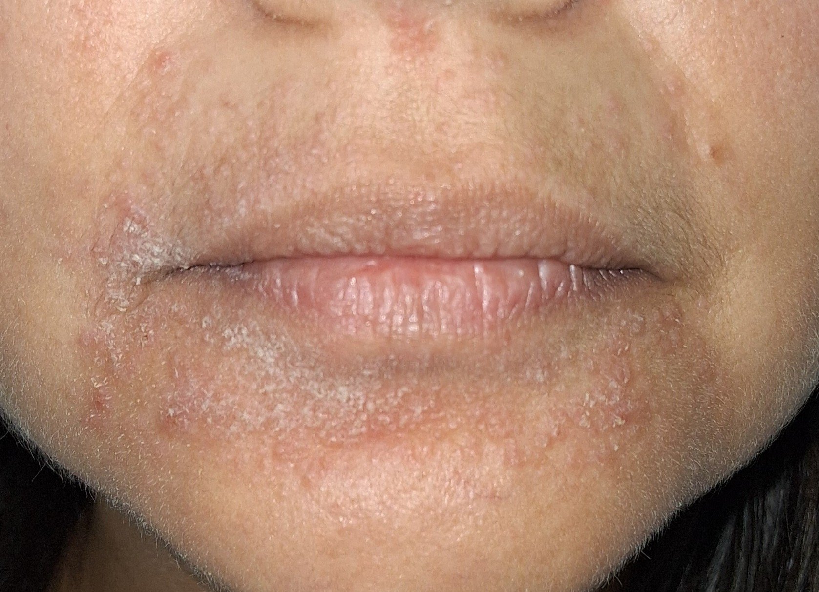 Clinical case of Perioral dermatitis