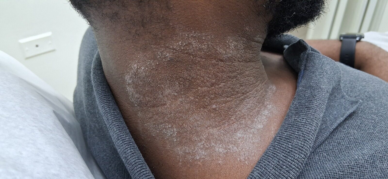 Contact dermatitis: before image