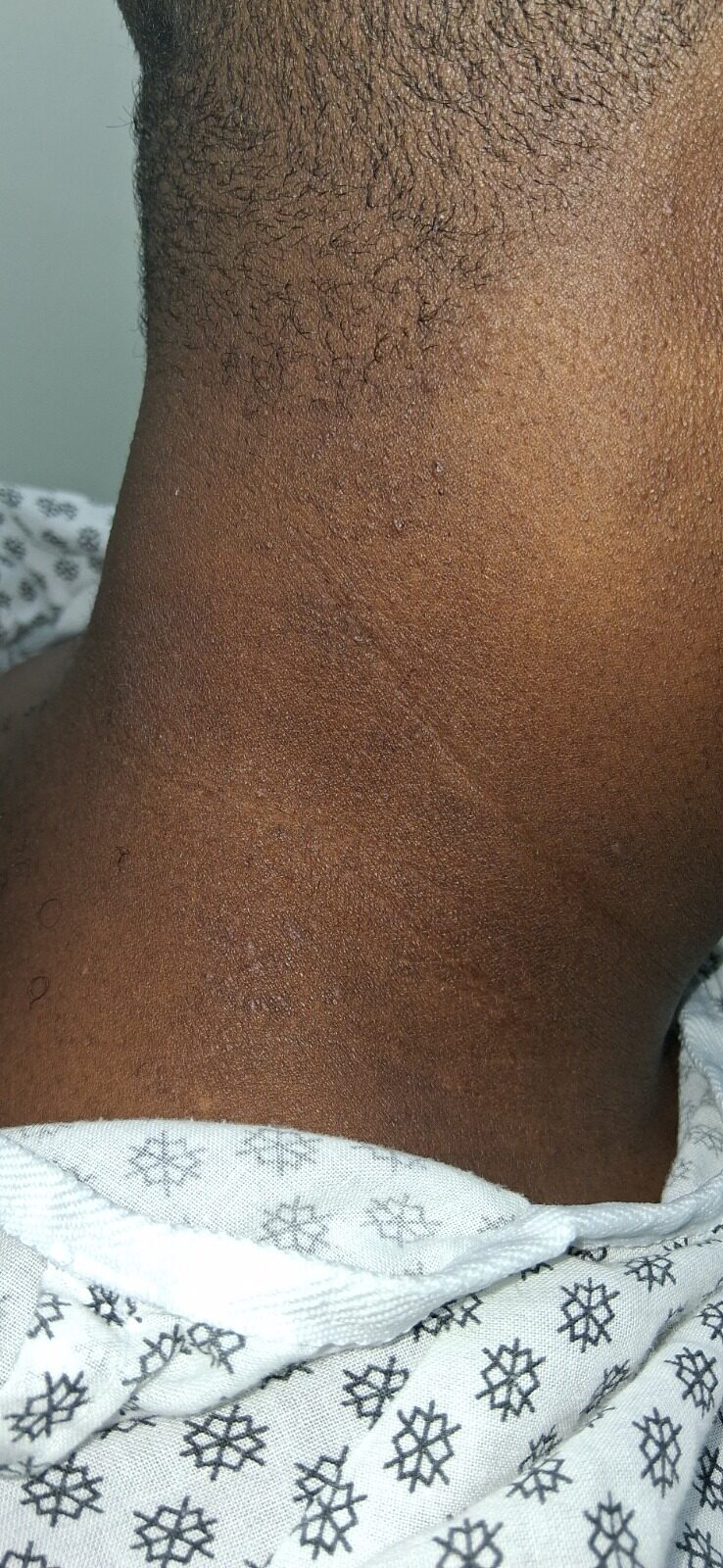 Contact dermatitis: after image