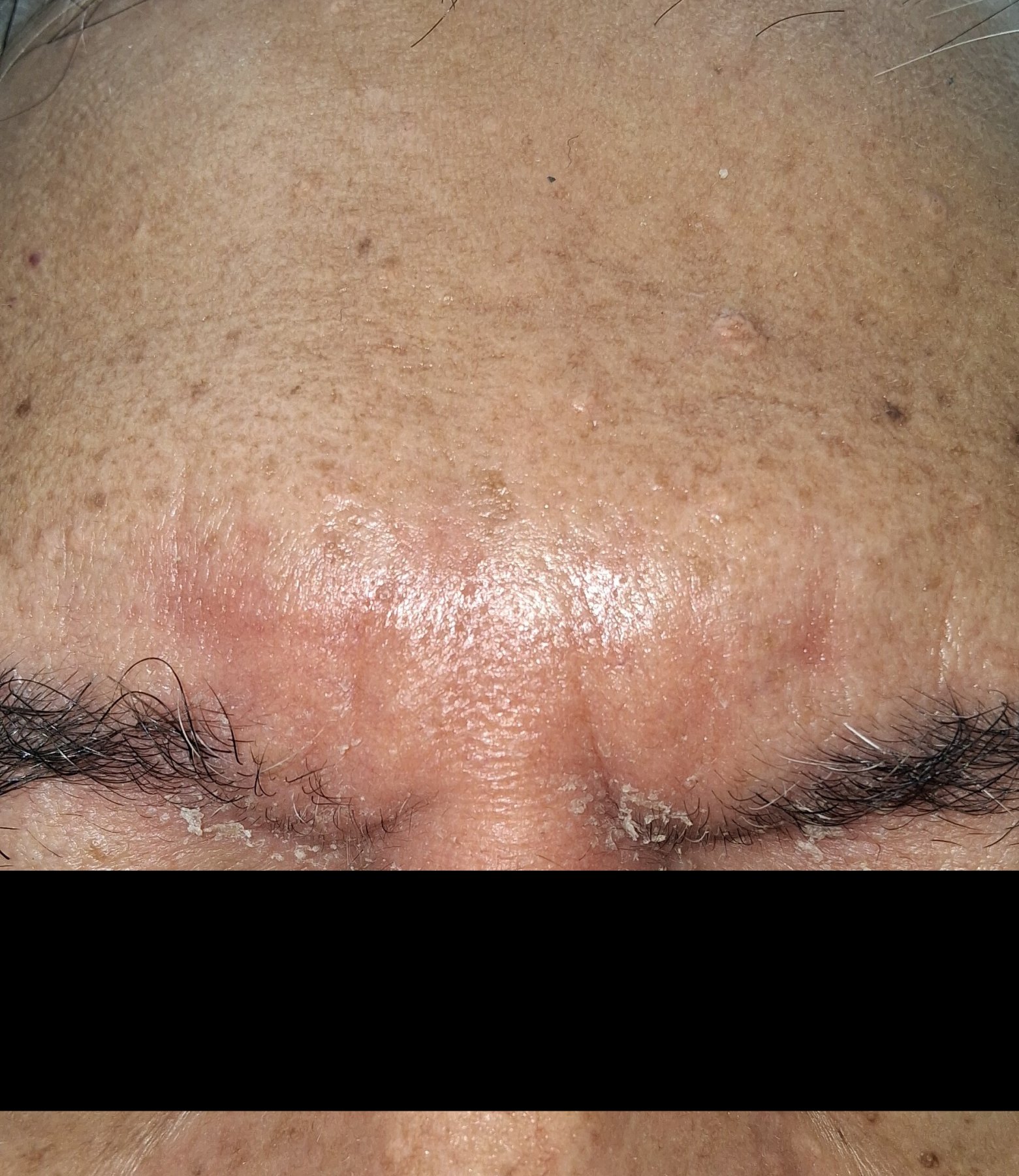 Seborrheic dermatitis: before image