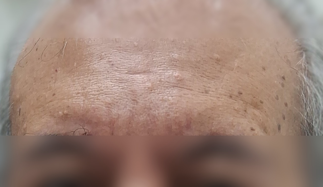Seborrheic dermatitis: after image