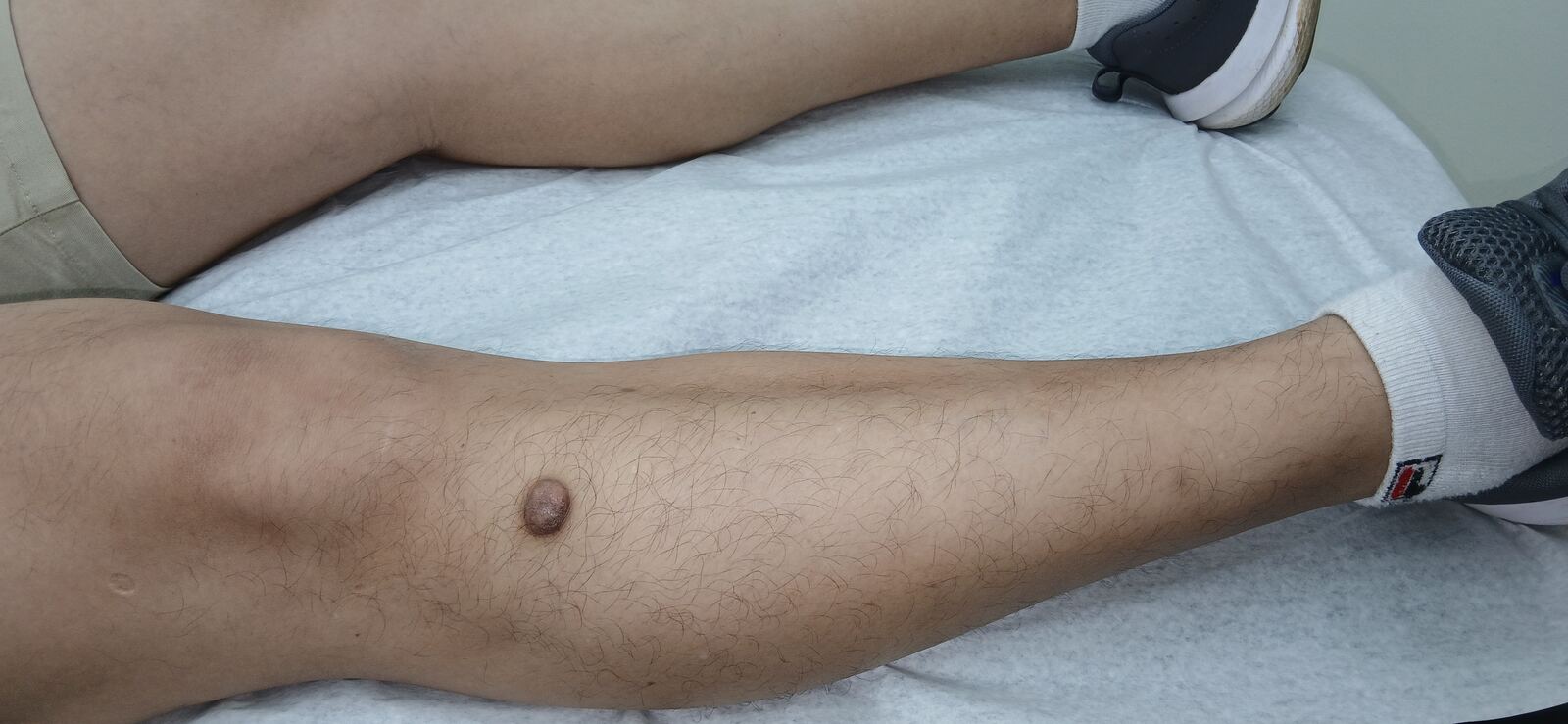 Dermatofibroma and keloid: before image