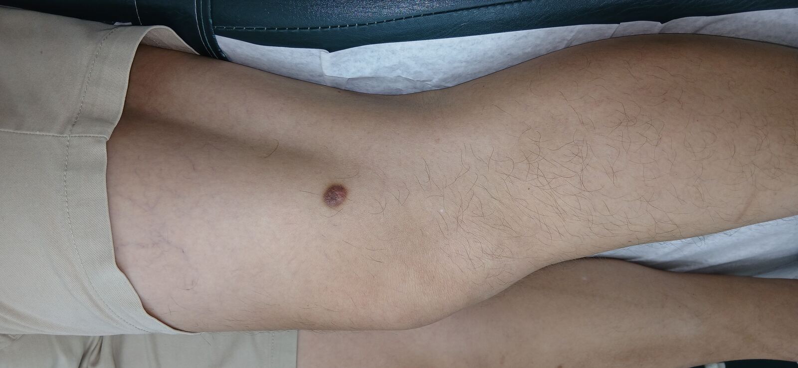 Dermatofibroma and keloid: after image