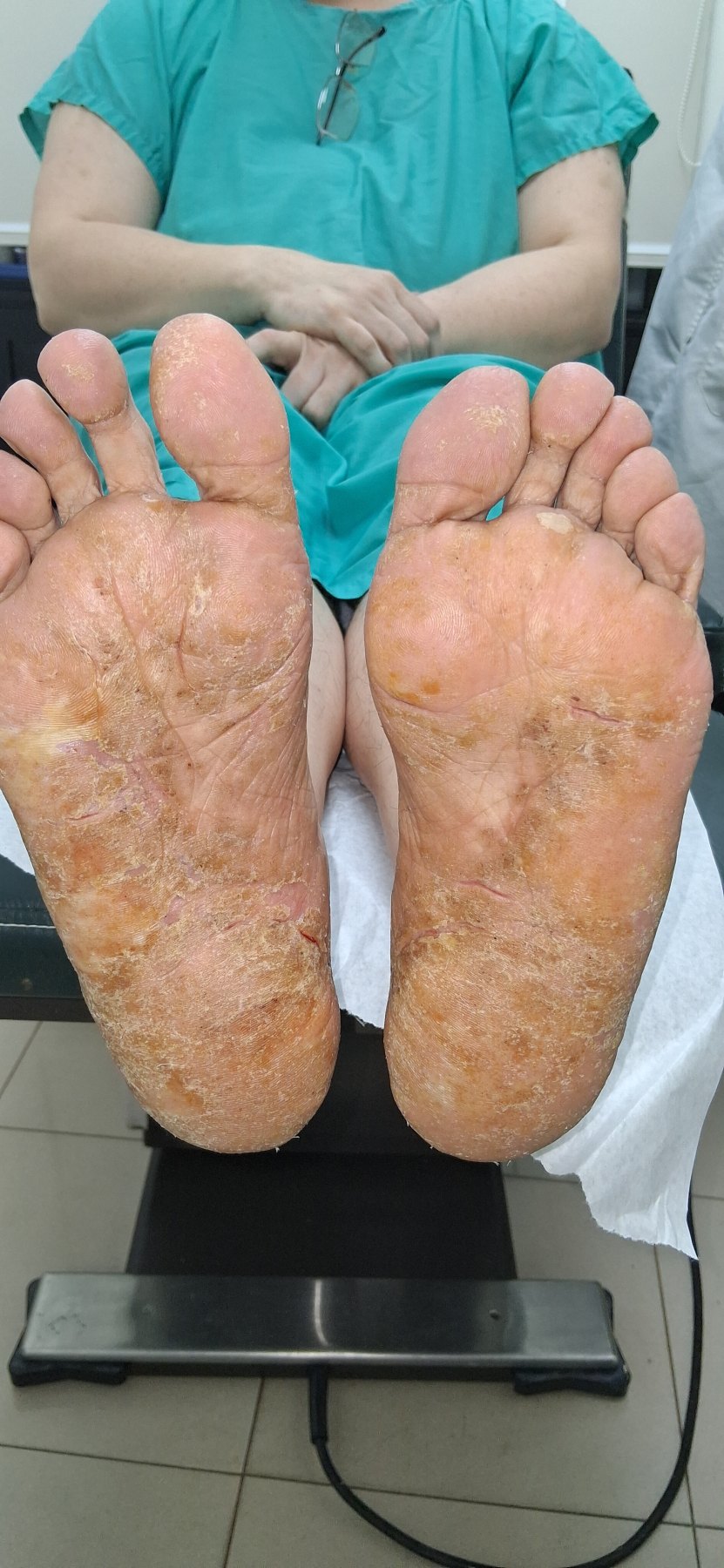 Dyshidrosis: before image
