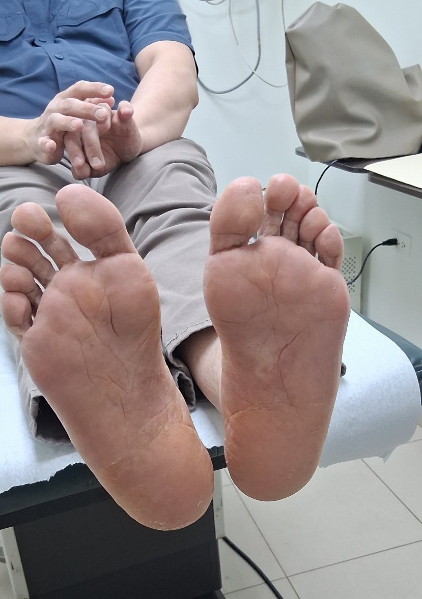 Dyshidrosis: after image