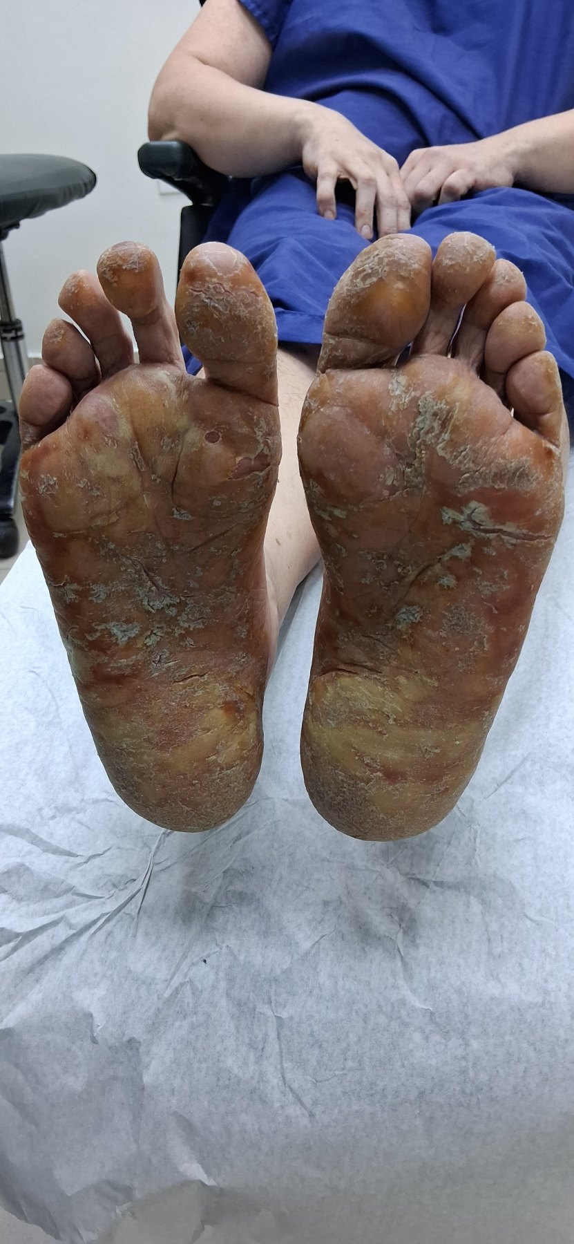 Clinical case of Dyshidrosis