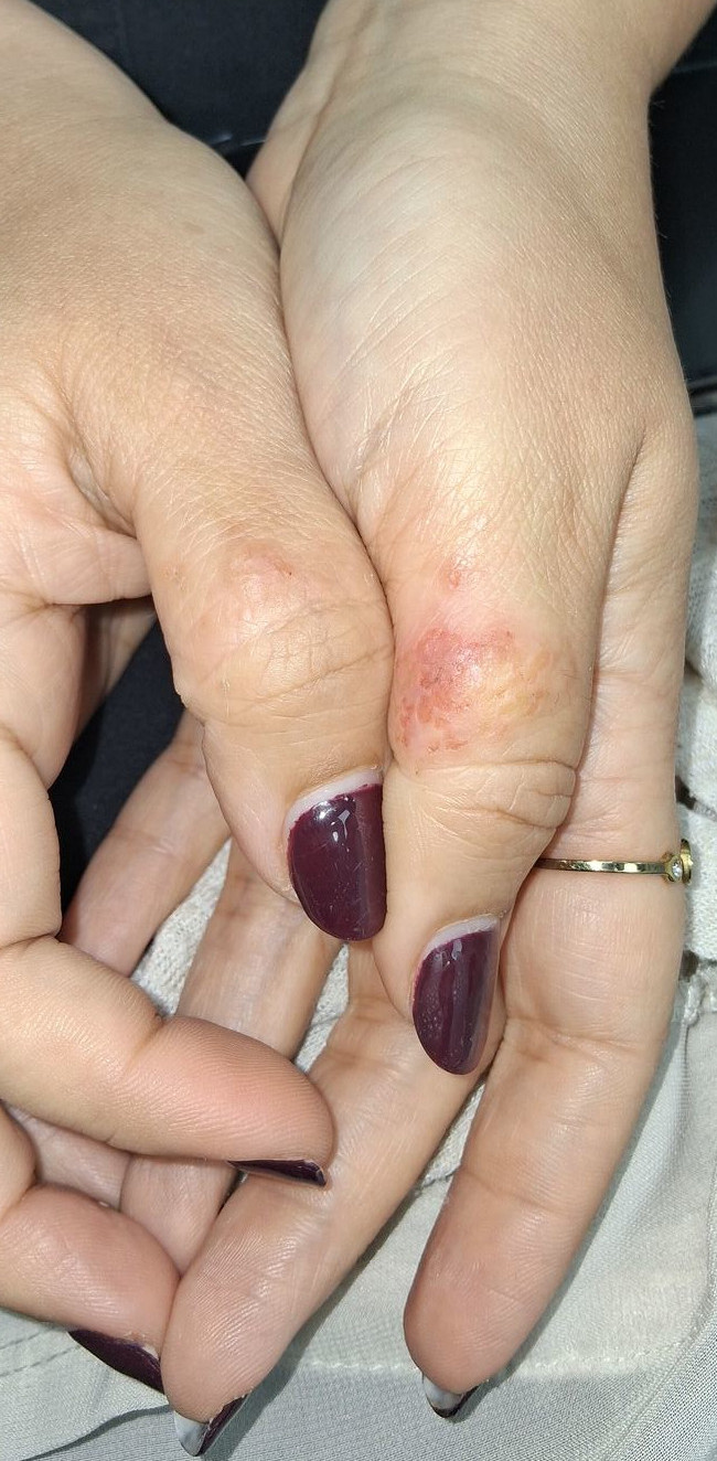 Atopic eczema: before image