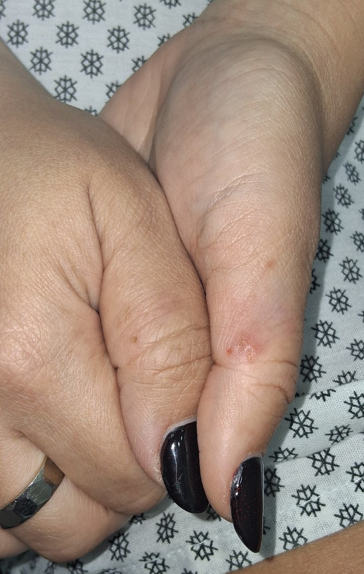 Atopic eczema: after image