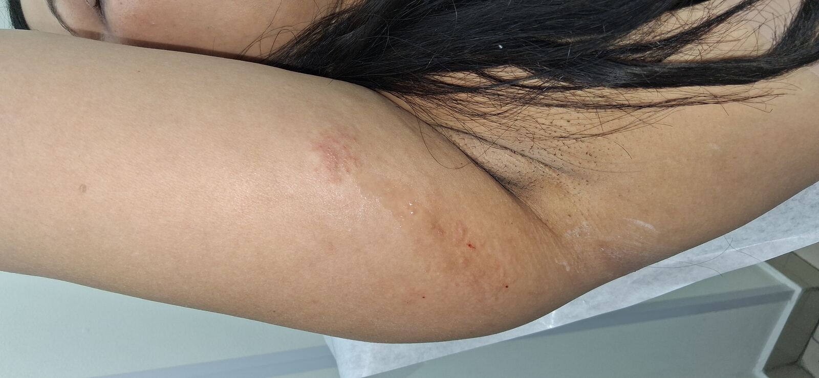 Clinical case: Atopic eczema
