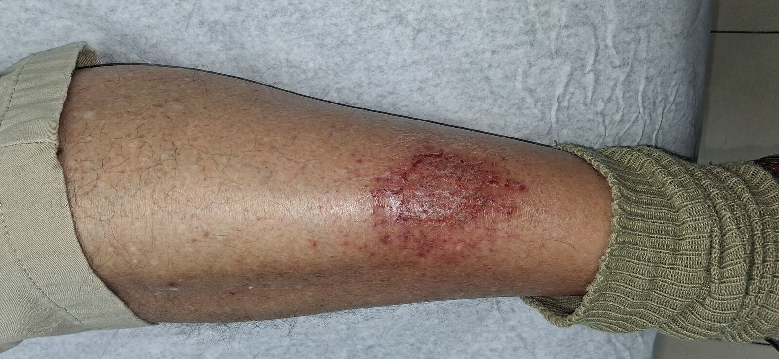 Stasis eczema and asteatotic dermatitis: before image
