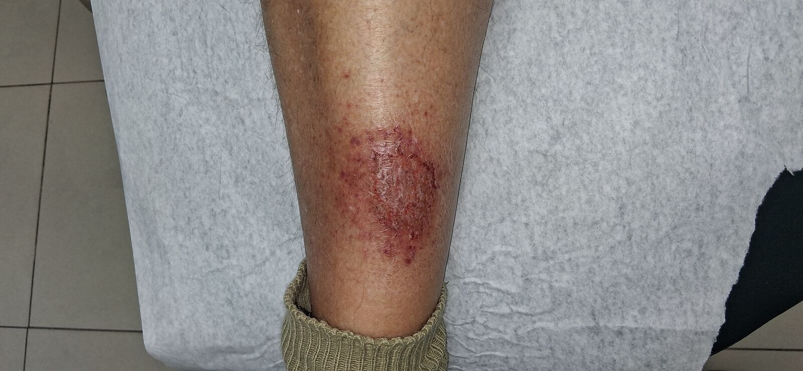 Stasis eczema and asteatotic dermatitis: after image