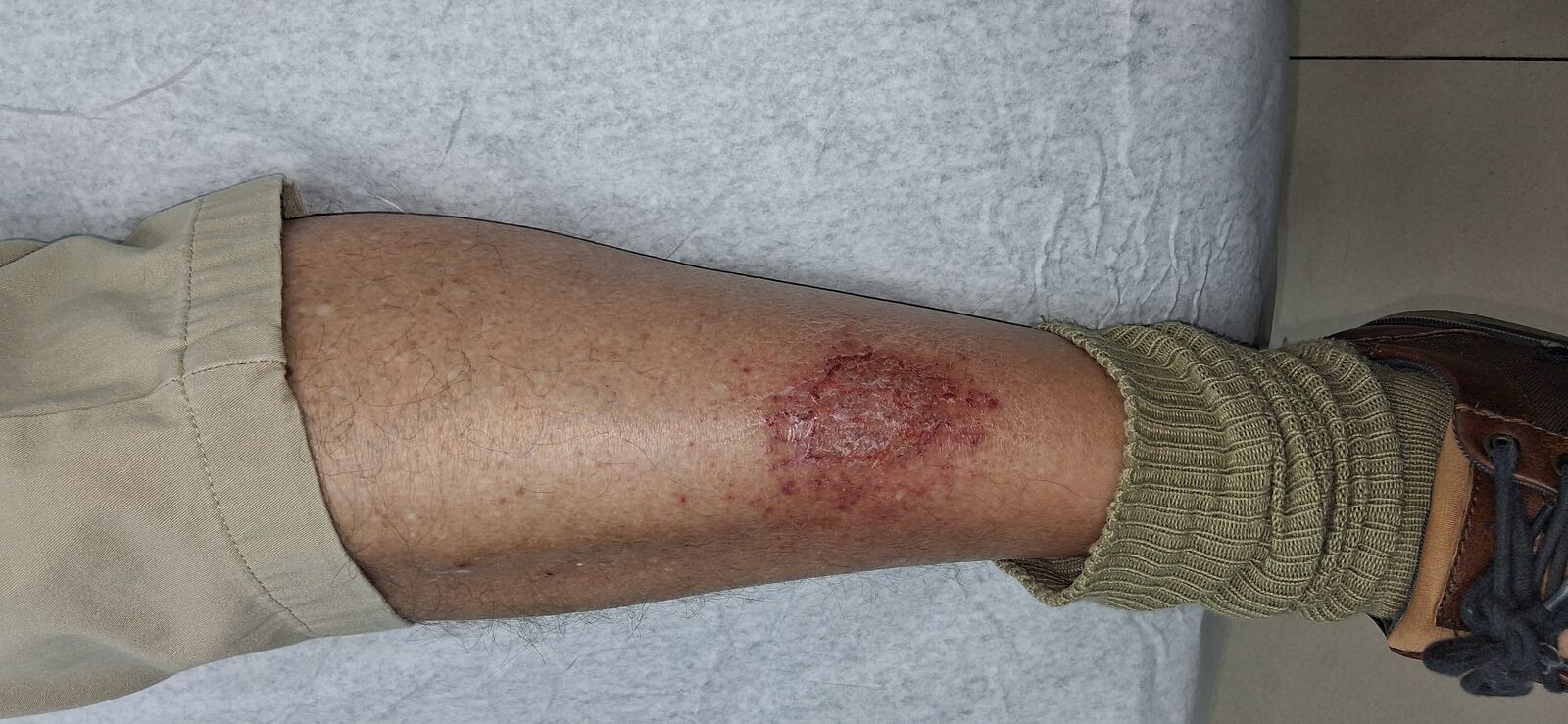 Clinical case: Stasis eczema and craquelé dermatitis