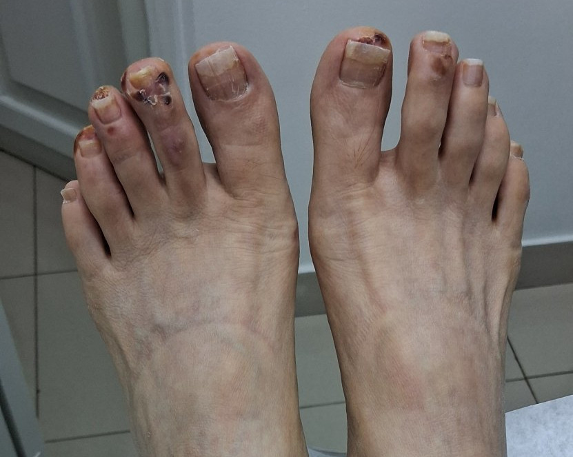 Dyshidrotic eczema: before image