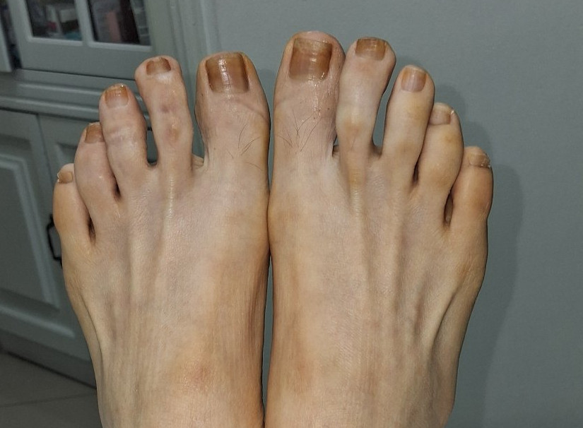 Dyshidrotic eczema: after image