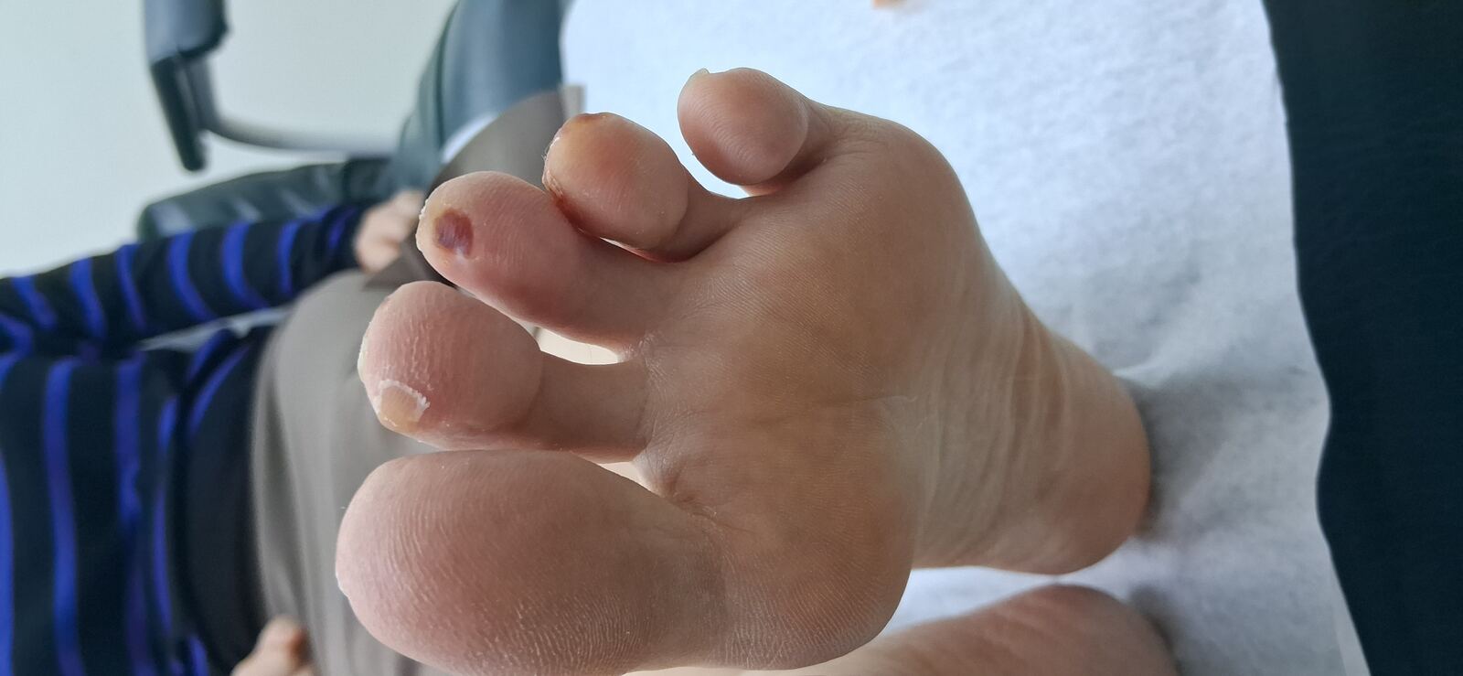 Clinical case: Dyshidrotic eczema