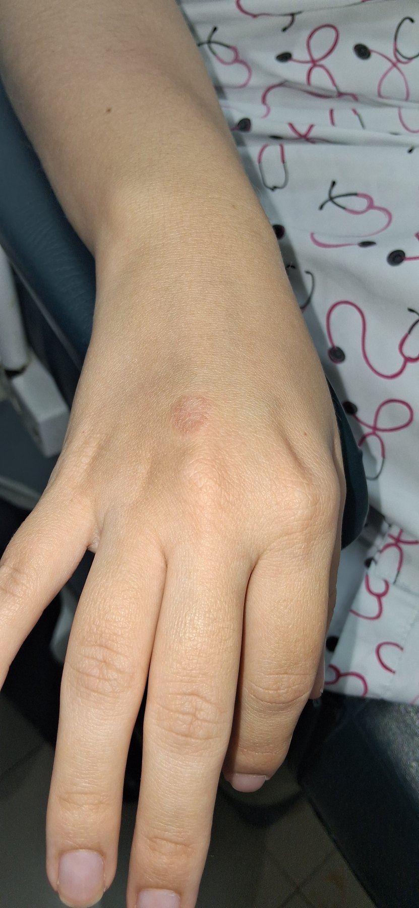 Nummular eczema vs tinea corporis: before image