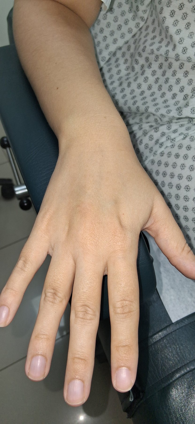 Nummular eczema vs tinea corporis: after image
