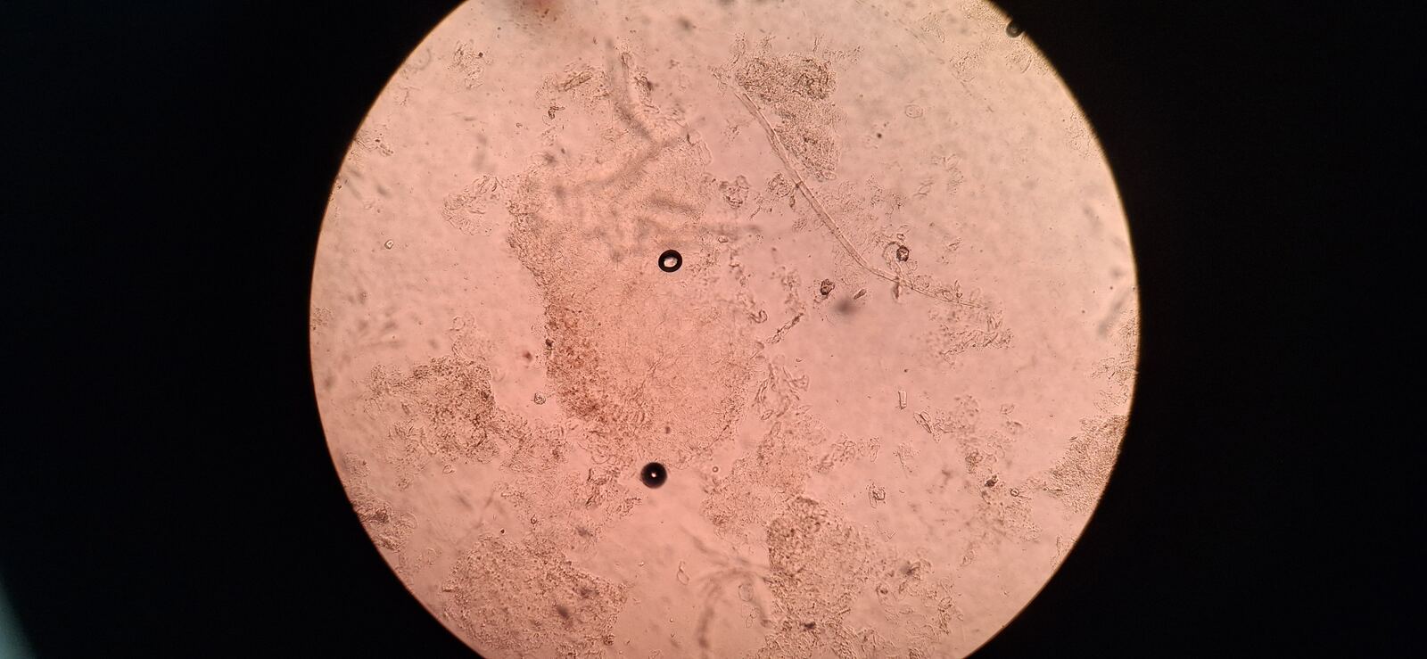 Clinical case: Nummular eczema vs tinea corporis