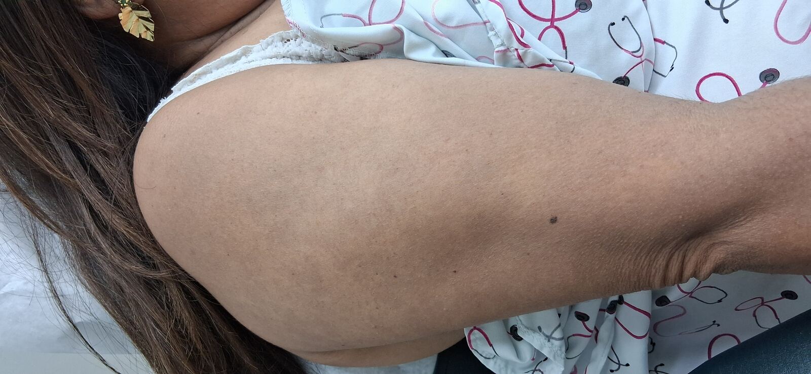 Erythema dyschromicum perstans: before image