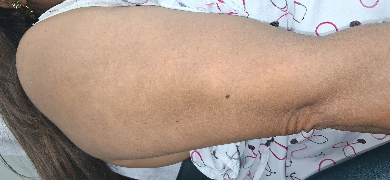 Clinical case: Erythema dyschromicum perstans