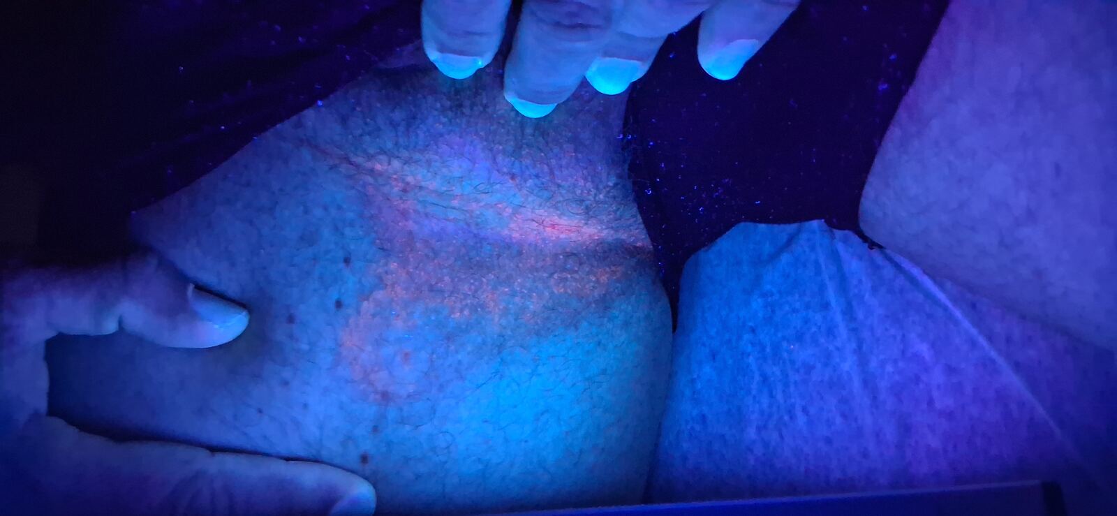 Erythrasma: before image