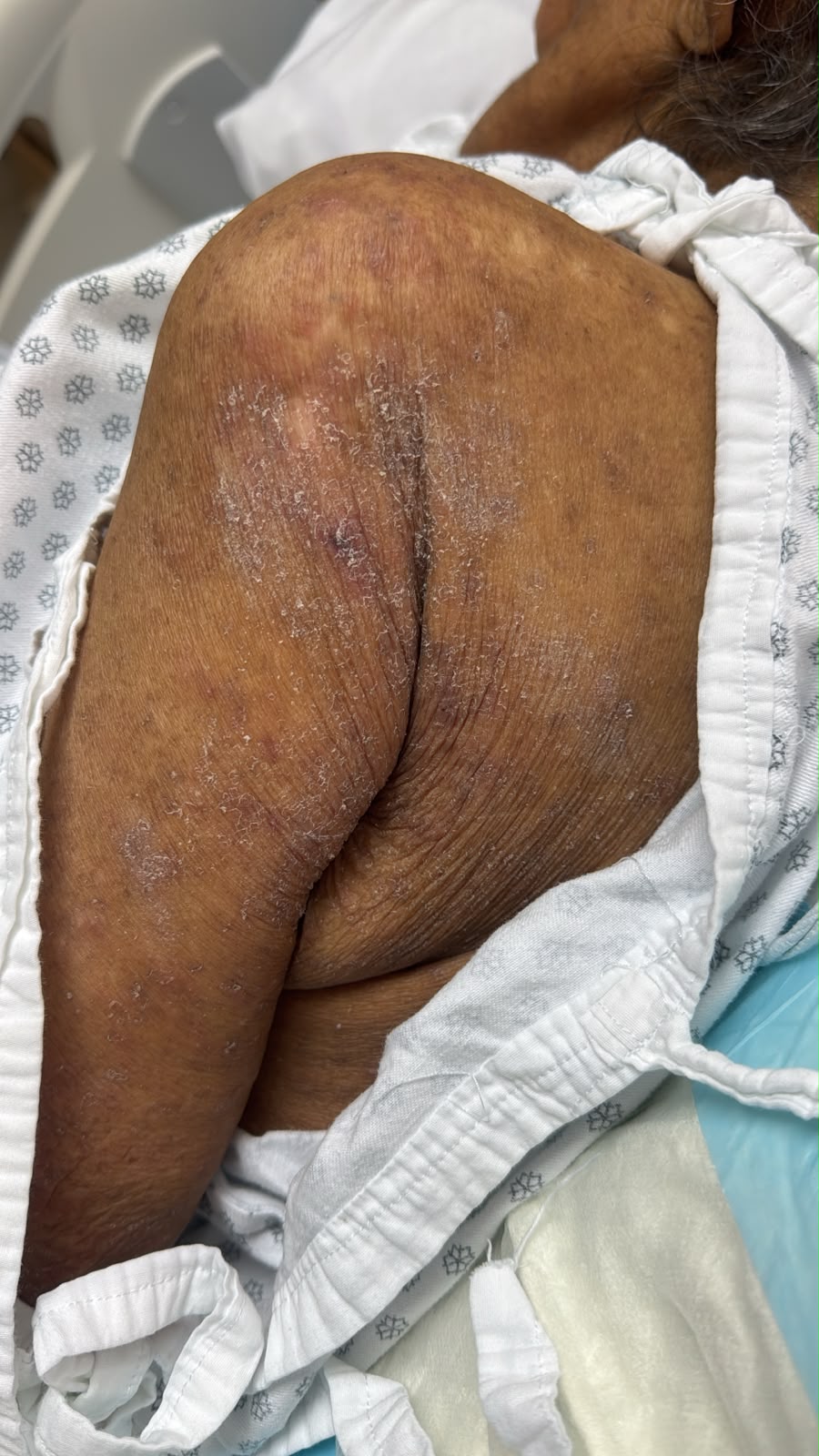 Scabies: before image