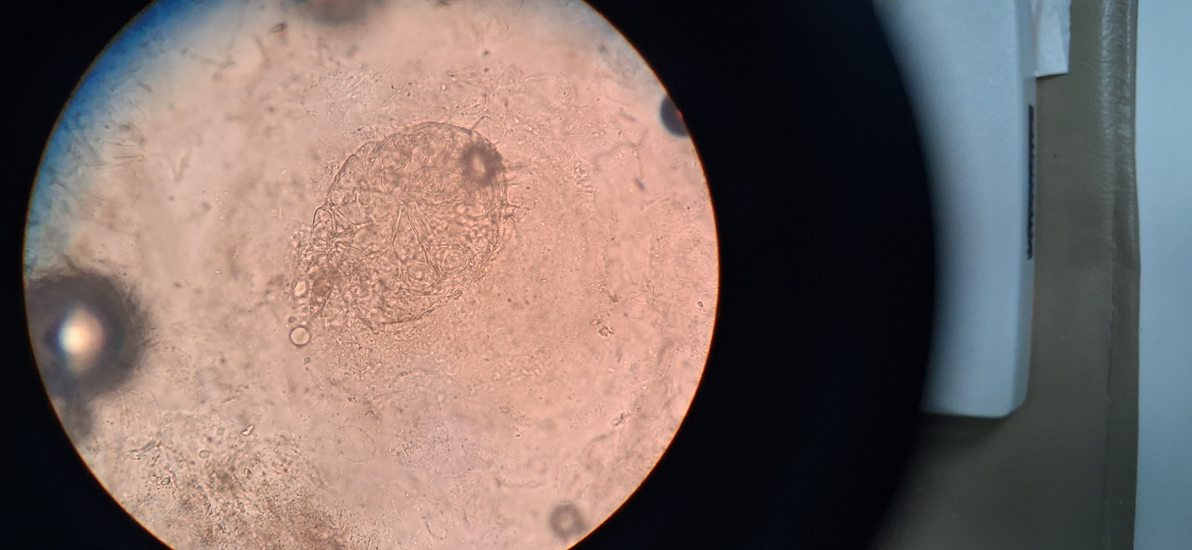 Scabies: after image
