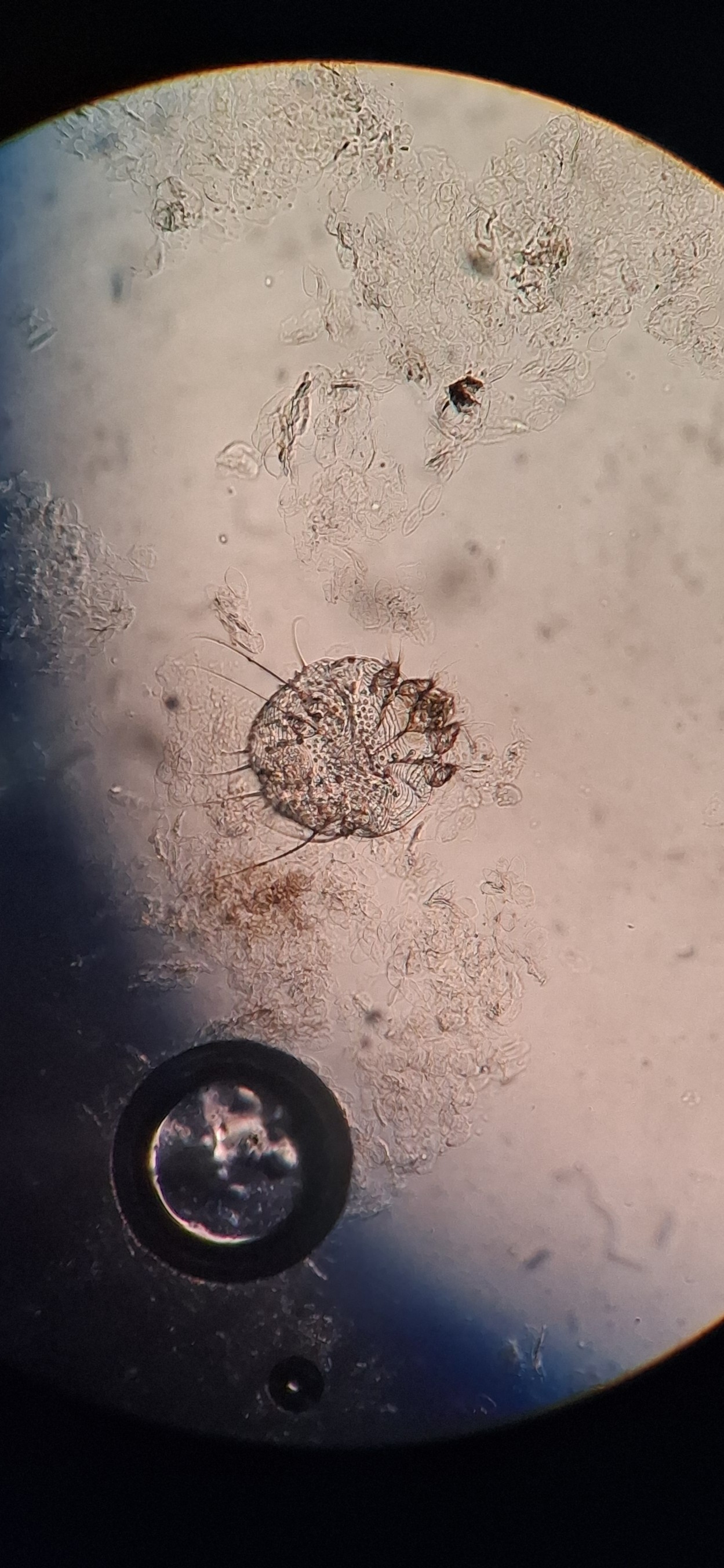 Clinical case of Scabies