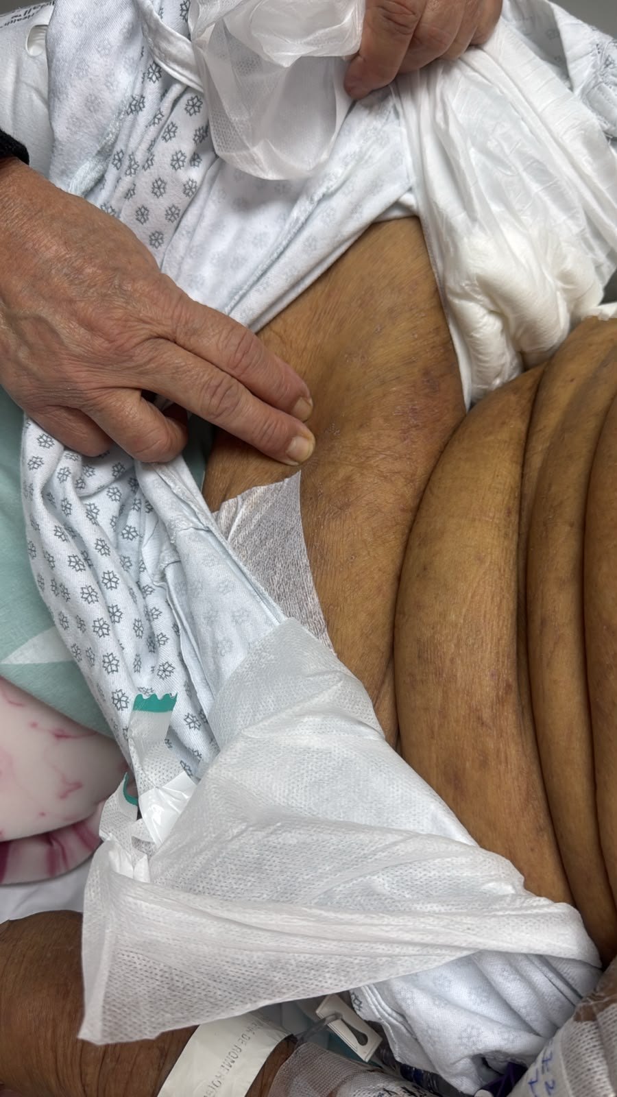 Scabies: after image