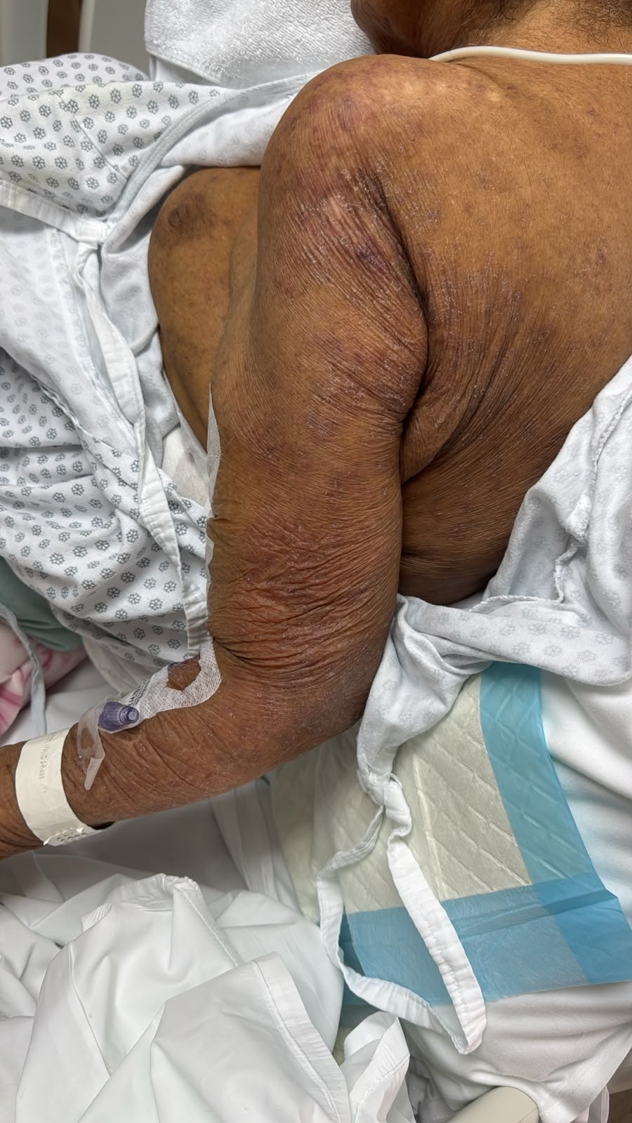 Clinical case of Scabies