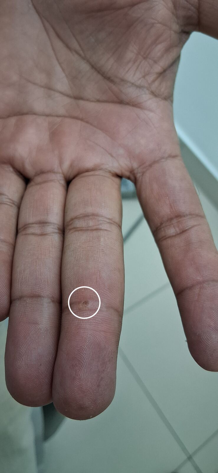 Fibrokeratoma vs wart: before image