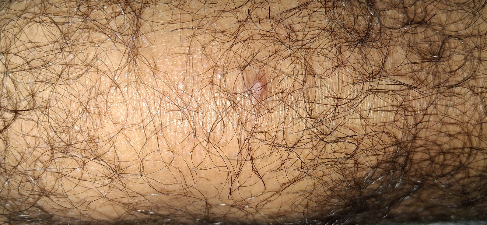 Fibrokeratoma vs wart: after image