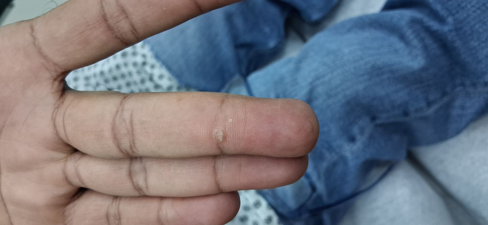 Clinical case: Fibrokeratoma vs wart