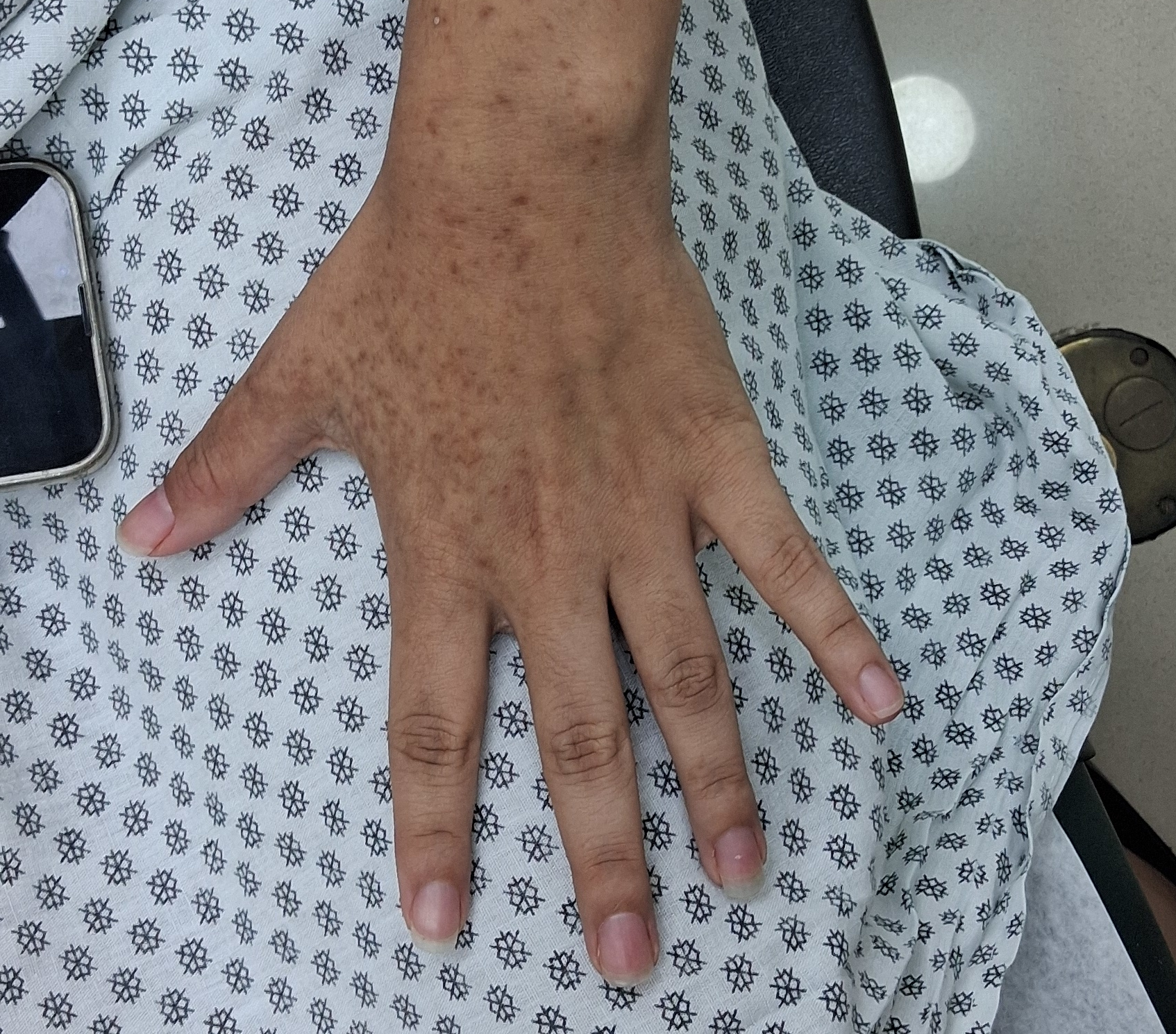 Phytophotodermatitis: before image