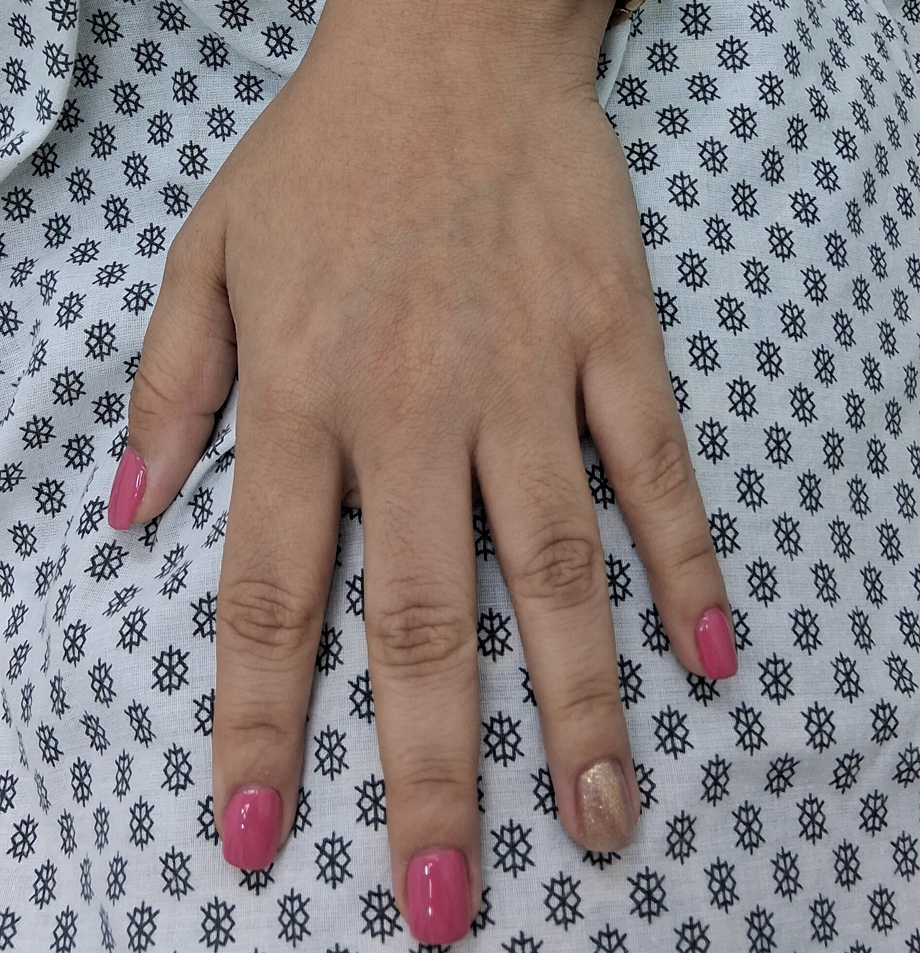 Phytophotodermatitis: after image