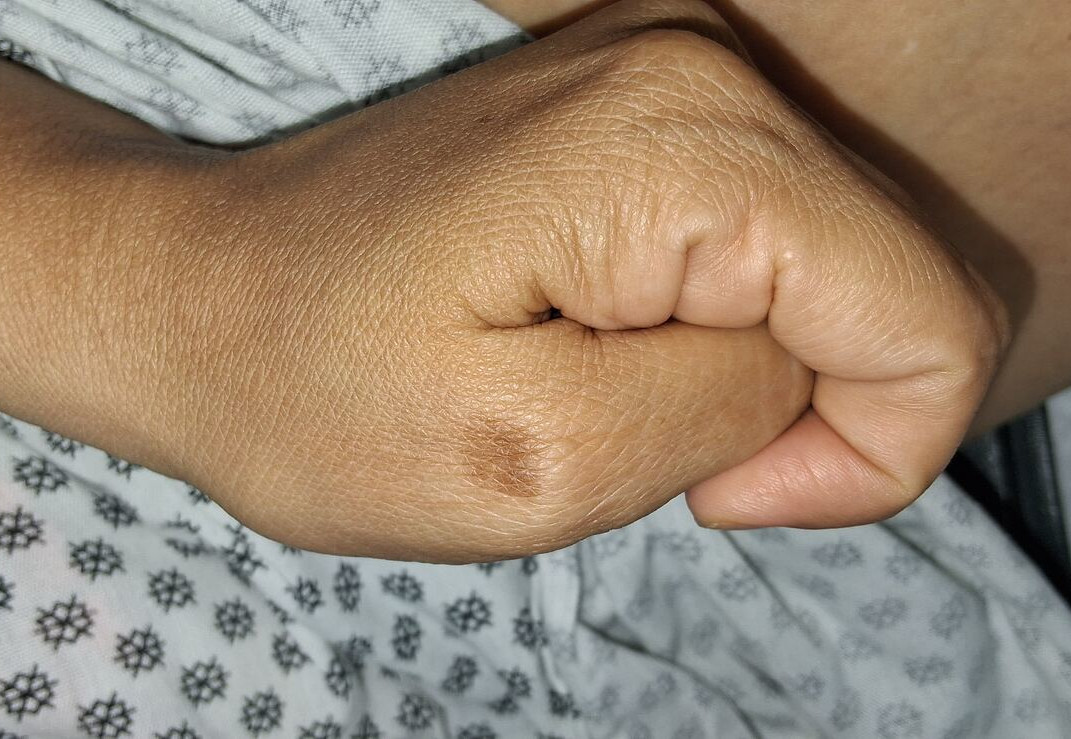 Clinical case: Phytophotodermatitis