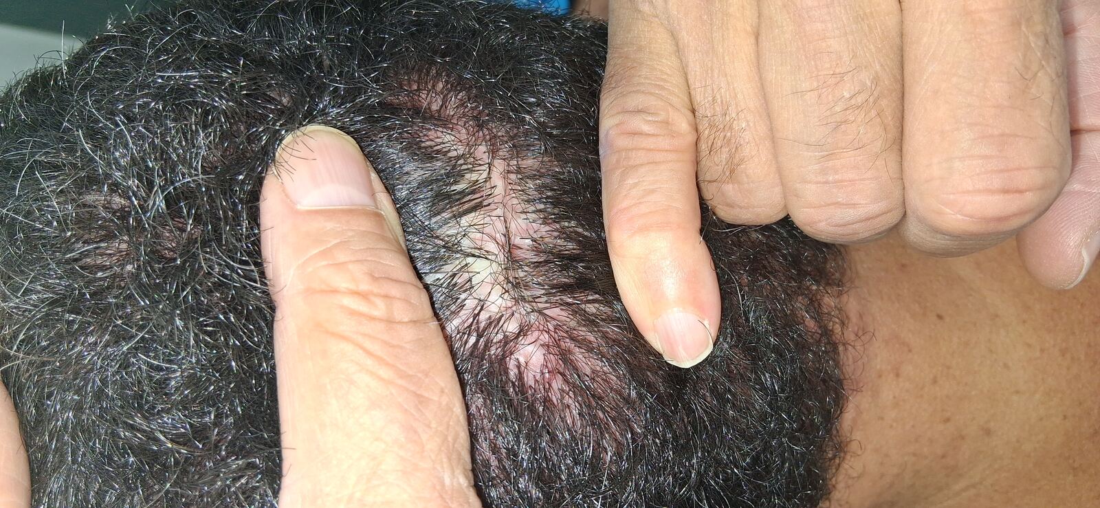 Folliculitis decalvans: before image